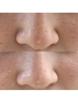 リンクアンドボーテ 大垣(Link&Beaute)/お悩み: 毛穴.くすみ　２０代