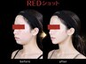 【脂肪集中ケア】REDショット打ち放題(顔・二の腕OK)/ ¥28,000