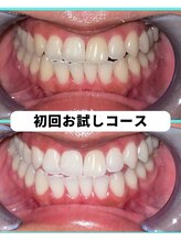 ホワイトニングビューティー 吉祥寺店/ホワイトニング　初来店