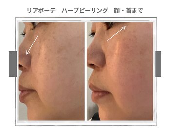 ラ ルーチェ 星田/幹細胞ハーブピーリング