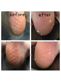 ラリベルテ(La liberte)/足裏角質ケア