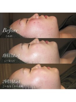 ウルケ(URUKE)/ハーバルピール