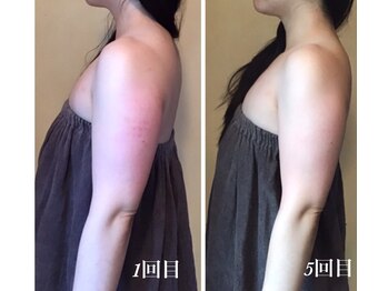 リリアーナ(LILIANA)/1箇所痩身モニター様/途中経過