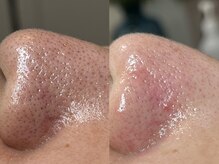 フレーズ(fraise)/毛穴エクストラクション