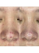 フルール ニコ(Fleur Nico)/2回のBeforeAfter