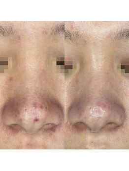 フルール ニコ(Fleur Nico)/2回のBeforeAfter