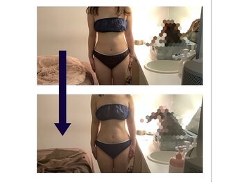 アクア エステティコ 亀有(ACQUA estetico)/脂肪燃焼6回