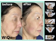 サロンフィーユ(Fille)/ハリ・弾力・引き締まったお顔