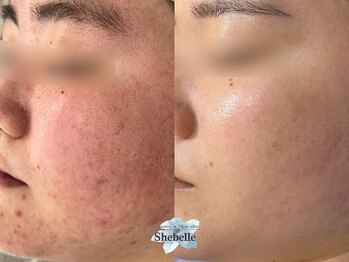 シーベル 代官山/症例写真/ハーブピーリング