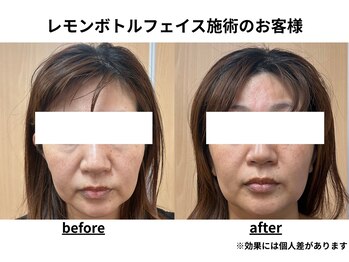 トータルビューティーみつとも/レモンボトル/顔のたるみ/二重顎