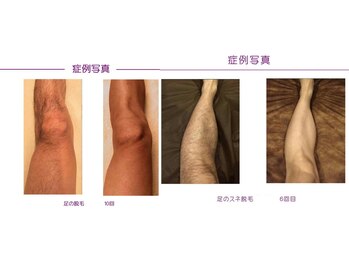 rvコーディネイトサロン(rv coordinate salon)/効果抜群LED脱毛体験してみて!