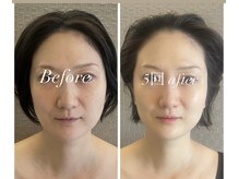 アリィ(Alii)/リフトアップ＆肌質も変えます