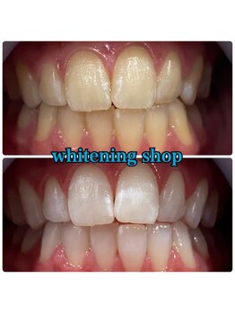 ホワイトニングショップ 三田店/before after