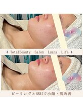 ルアナライフ(Luana Life)/20代・ソフトピーリング＋HARI 