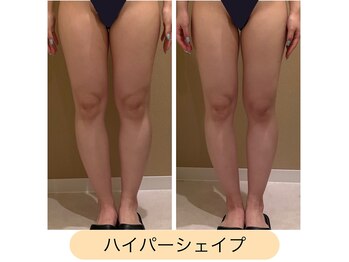 クレヴィア バイ サイバーエステ(CREBIA)/脚のラインをスッキリ!