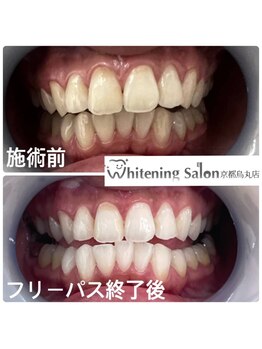 ホワイトニングサロン 京都烏丸店/ホワイトニング施術例