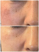 プリュネル(Prunelle)/プラズマシャワー