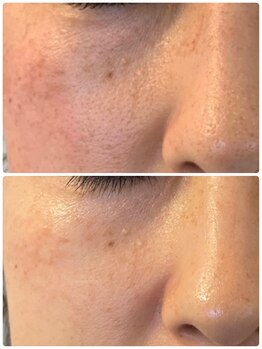 プリュネル(Prunelle)/プラズマシャワー