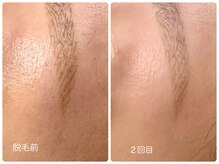 シシエル(CHICIEL)/眉周り光脱毛 顔脱毛で美肌に♪