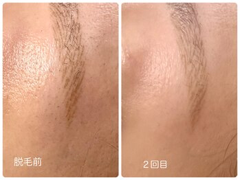 シシエル(CHICIEL)/眉周り光脱毛 顔脱毛で美肌に♪