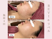 ルア(LuA.)/フェイスラインの肌荒れ改善◎