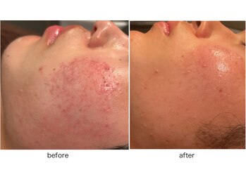 アミュレット(AMULET)/ニキビ改善コース/10代症例