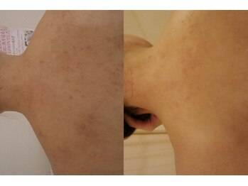 れふぇるん 足利店/背中肌あれケア 5ヶ月