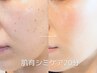 シミが多めの方に！【肌育リフト＆シミケア20分(2mm大×30個目安)】