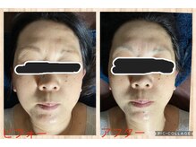 リンパサロン ニナ(nina)/REVIハーブピーリング