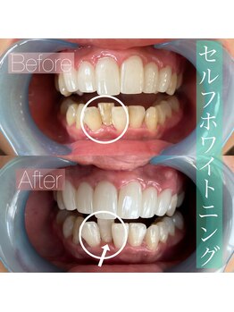 アンジュリー(angelie)/美歯を目指しましょう!