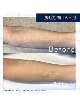 メンズクリア 草津店/【メンズクリア】お客様の施術例