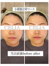 セリア(CELIA)/小顔矯正/小顔//面長/エラ張り