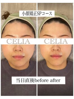 セリア(CELIA)/小顔矯正/小顔//面長/エラ張り