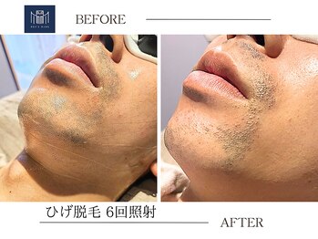 メンズメイド(Mens'Made)/before / after