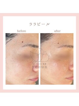 ヨウン 大阪心斎橋(yeoun)/ララピール/ララピール大阪