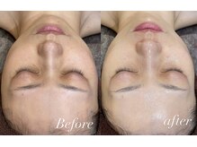 レシェルサロン(Lechelle Salon)/ダクトピーリング