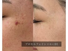 ル シーニュ/プロセルフェイシャル×3回