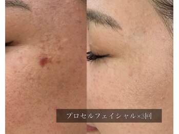 ル シーニュ/プロセルフェイシャル×3回