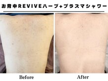 リッチ(Rich+)の雰囲気（大人気背中ハーブピーリング7回での効果です◎背中のお悩みに◎）