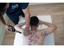 鍼灸整骨院ACT/頑固なコリは吸い玉を。