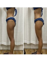 ハリルル 併設 GLケンタ鍼灸整骨院(HARILULU)/桃尻・ヒップアップ