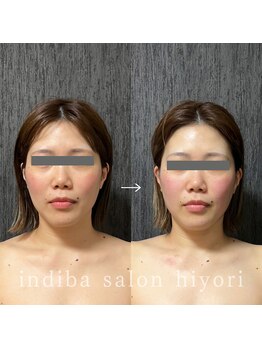 ヒヨリ(hiyori)/《before/after》フェイシャル