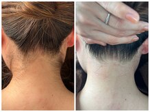 シロ(Shiro)/うなじのデザイン脱毛