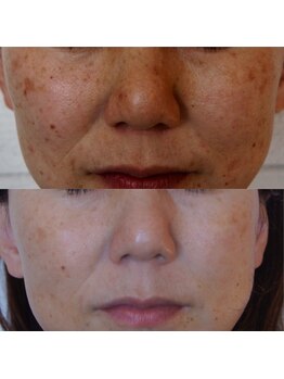 ザ シー タイムレスビューティ(THE SHE)/40代お客様症例写真