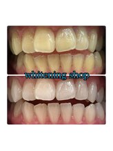 ホワイトニングショップ 大阪玉造店/Before&After美白ホワイトニング