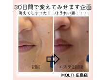 モルティー 広島店(Molti)/消えてしまった!ほうれい線
