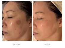 ボンクール(BONCOEUR)の雰囲気(途中経過(Y様40代・施術1回/期間2週間))