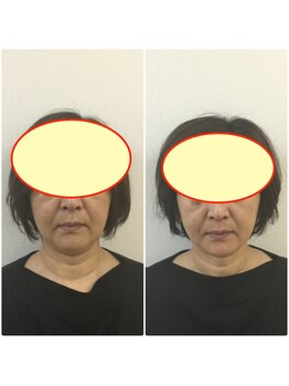 やち鍼灸院/人気の小顔整体！