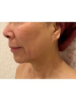 ホウレイ線・たるみ改善！予防ケア