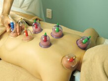 ビューティーボディー 小岩(Beauty Body)/カッピング（吸い玉）